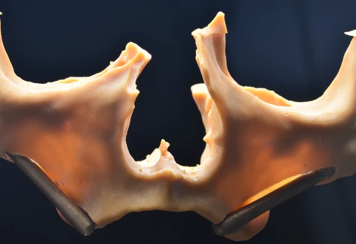 Implantes Zigomáticos: Uma Revolução na Odontologia - Descubra a História!